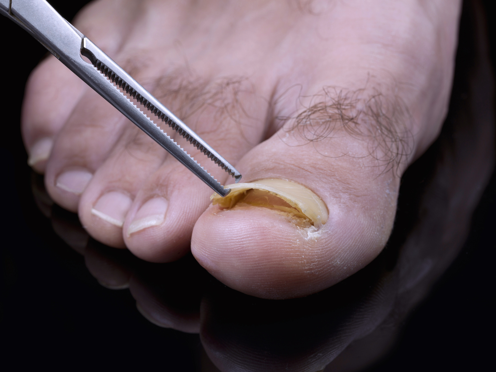 A photograph of a foot with a fungal infection of the toenails